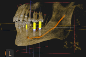 implantes-01