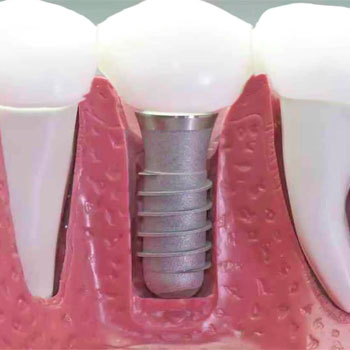 implantes dentales en zaragoza