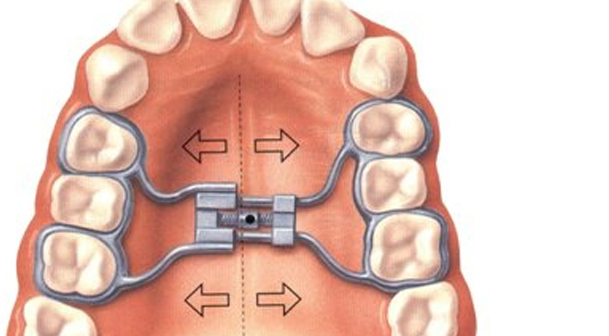 Ortopedia maxilar en Zaragoza, brackets para niños