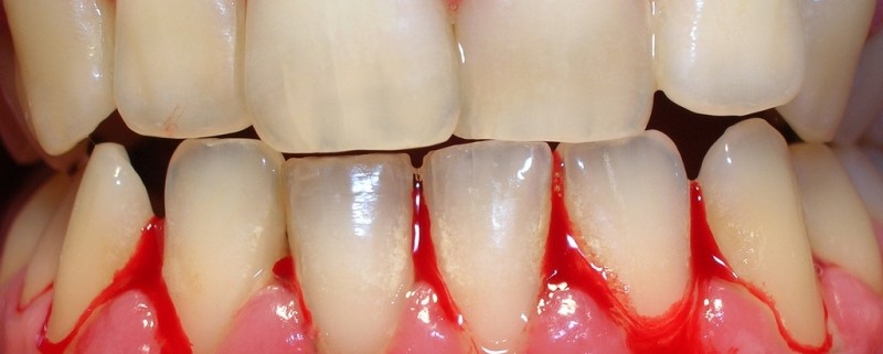 gingivitis encias