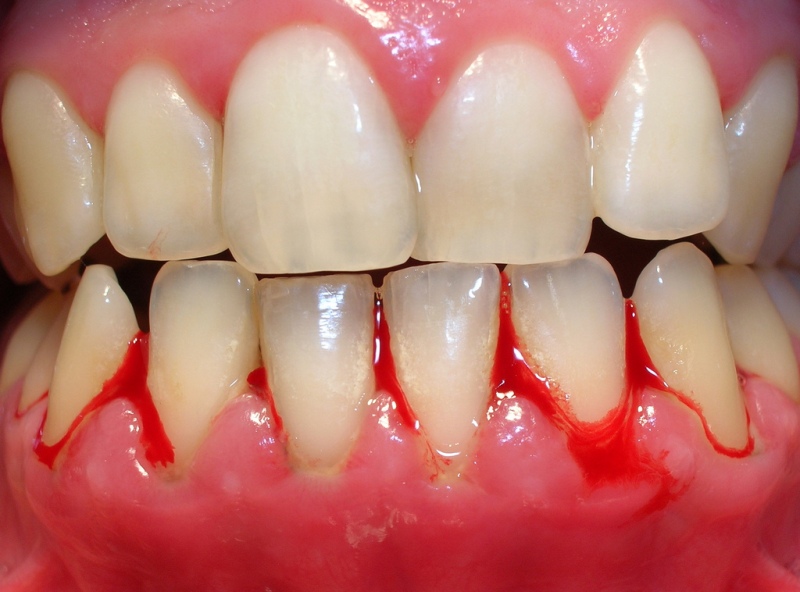 Gingivitis: Qué es y cómo evitarla - Clínica Dental Lorenzo