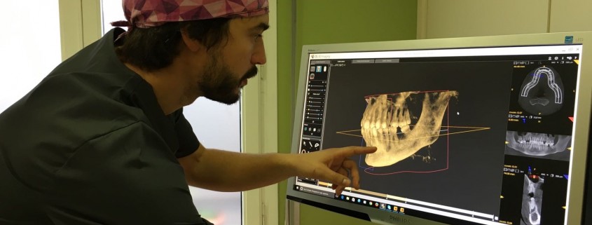pérdida ósea dental