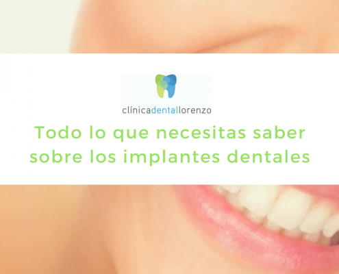 guia implantes dentales