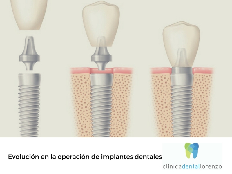 operacion implantes dentales
