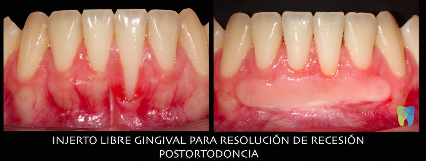 Recuperar las encías perdidas Clínica Dental Lorenzo