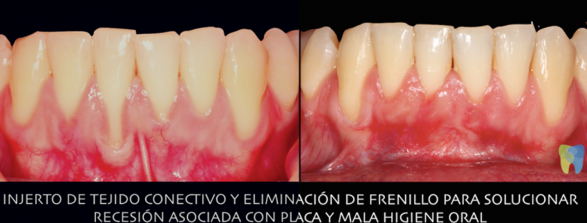 Recuperar las encías perdidas Clínica Dental Lorenzo