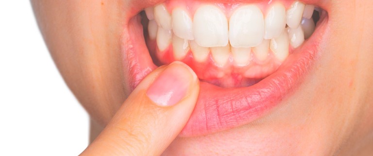 Recuperar las encías perdidas Clínica Dental Lorenzo