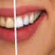 Manchas en los dientes por Tetraciclina