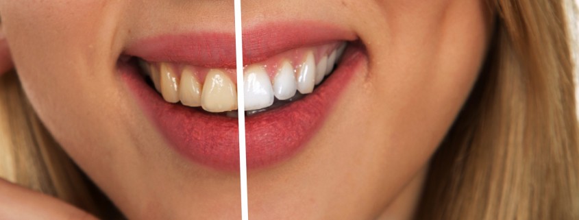 Manchas en los dientes por Tetraciclina