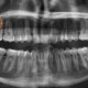 Muelas del juicio - Clínica Dental Lorenzo