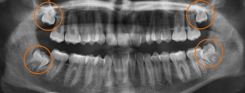 Muelas del juicio - Clínica Dental Lorenzo