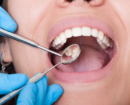 Caries dentales · Clínica Lorenzo Zarargoza