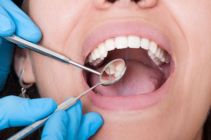 Caries dentales: causas, tipos y prevenirlas