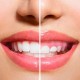 Gingivectomía Clínica Lorenzo Zaragoza