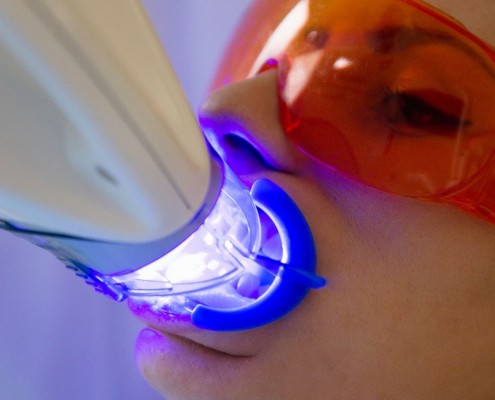 tratamiento blanqueamiento dental Zaragoza