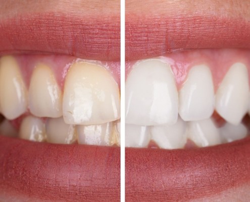 Blanqueamiento dientes Zaragoza