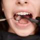 Periodonica en Zaragoza: Cuidado Periodontal