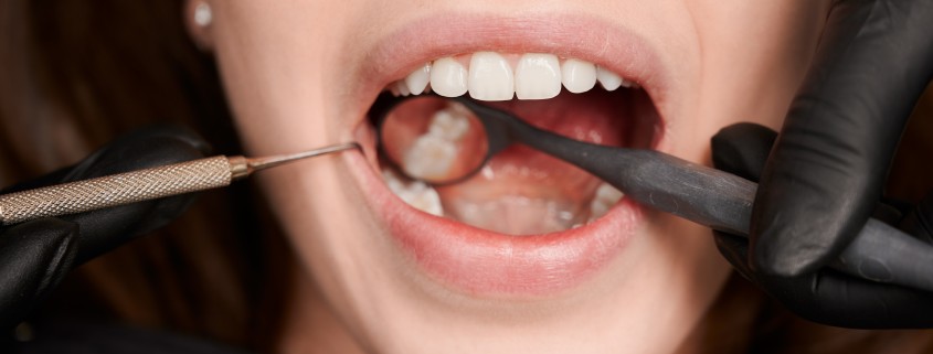Periodonica en Zaragoza: Cuidado Periodontal
